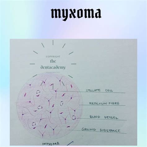 Myxoma | Pathology, Blood vessels, Diagram