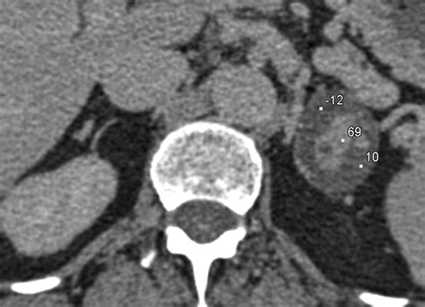 Adrenal Mass Imaging With Multidetector Ct Pathologic Conditions