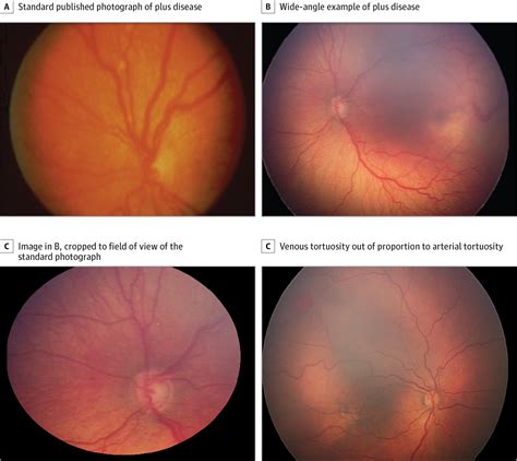 Expert Diagnosis Of Plus Disease In Retinopathy Of Prematurity From