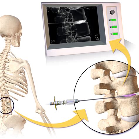 Genicular Nerve Block South Lake Pain Center Pain Management