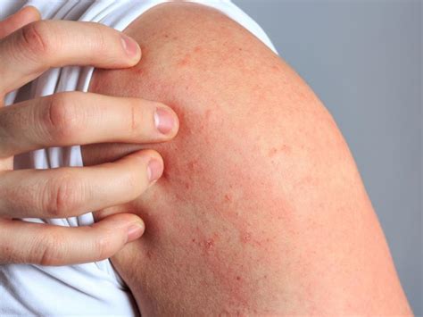 Scabies Rash On Back