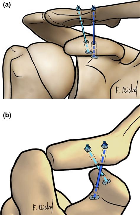 Coracoclavicular ligament reconstruction for the DCT technique with ...