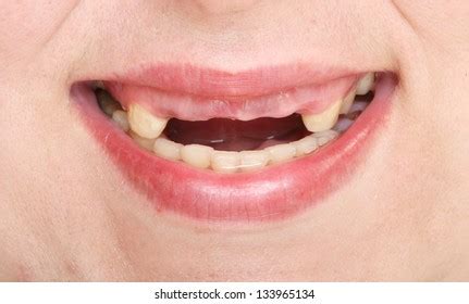 Picture Of Woman With Missing Teeth Teethwalls