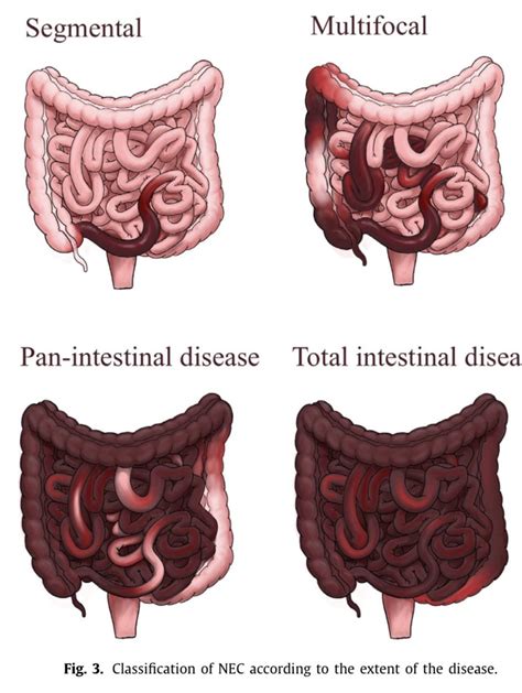 Cirugía Pediátrica on Twitter Clasificación de la enterocolitis