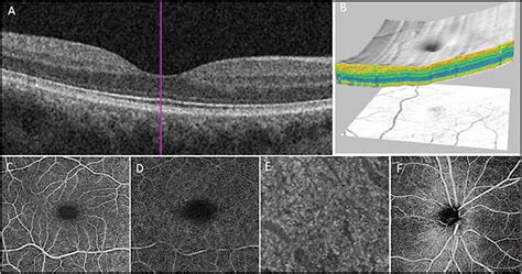 Three Dimensional Oct And Oct Angiography Imaging For Retinal Diagnosis