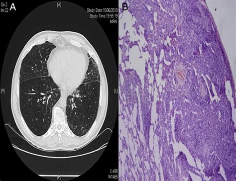 Diffuse Interstitial Lung Disease As A First Manifestation Of