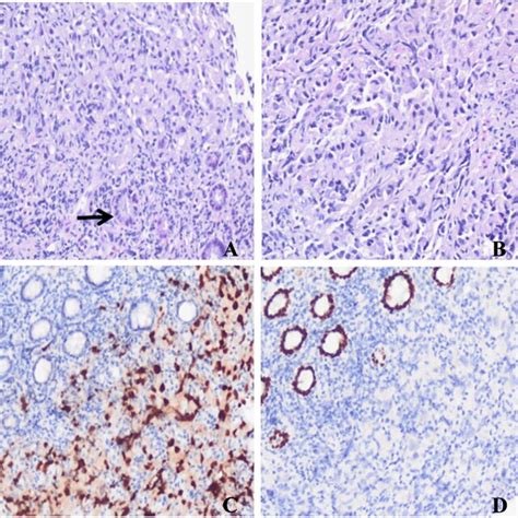 Hande And Immunohistochemical Ihc Staining Of The Tumour At The