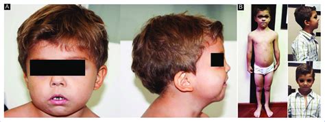 A: frontal and lateral phenotypic features of Robinow syndrome ...