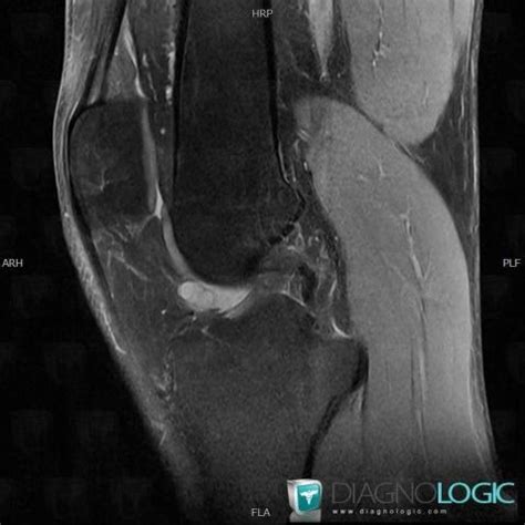 Cas Radiologie Kyste Muco De Irm Diagnologic