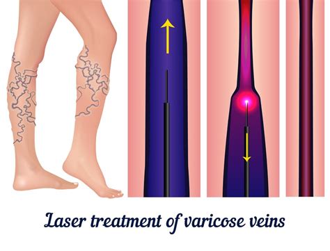 Varicose Veins Treatment Korea Laser Varicose Veins Removal In Seoul