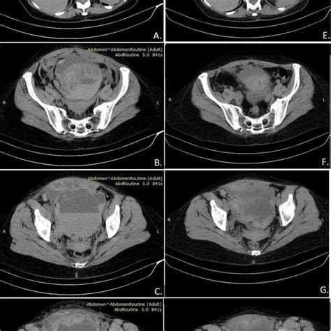 Retroperitoneal Haematoma First Ct A B C D And Control Ct On The