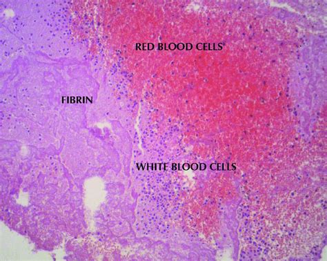 Photograph With Optical Microscope Of Recent Thrombi Characterized By