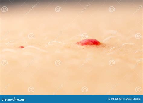 Birthmark On A Person`s Skin As A Background Stock Photo Image Of