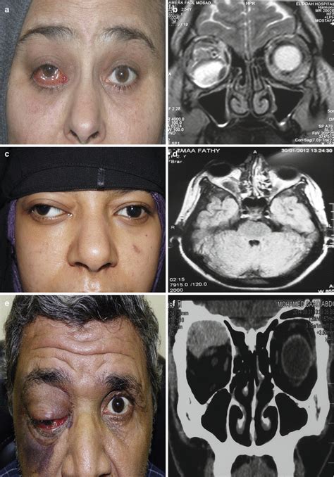 Retrobulbar Hematoma