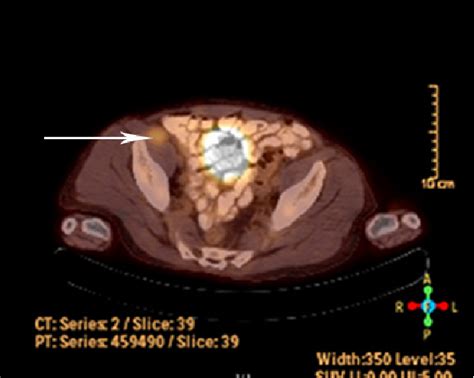 Figure From Retroperitoneal Ancient Schwannoma A Case Report And