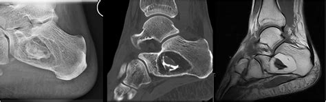 Intraosseous Lipoma Of The Calcaneus Showing Typical Central