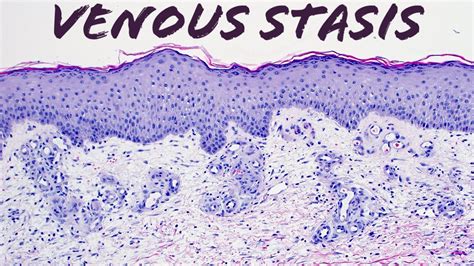 Venous Stasis Vascular Change Pathology Dermatology Dermatopathology