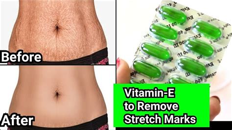 How To Remove Stretch Marks From All Body Part Stretch Mark Khatam