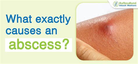 What Causes An Abscess Does It Hurt To Drain Pus Intouchmedicare