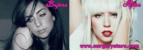 Lady Gaga Plastic Surgery Before After Pictures