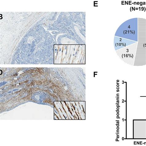 Representative Images Of Podoplanin PDPN Expression In The Cytoplasm