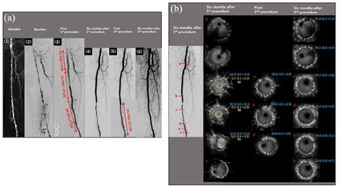 Ct Angiographic And Ivus Findings Of The Left Sfa A Ct And Download Scientific Diagram