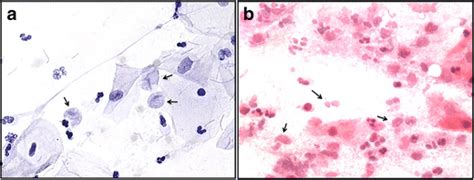 A Photomicrograph Of A Pap Smear Trichomonas Vaginalis Tv Is