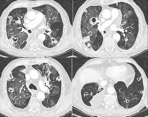 Pneumocystis In Metastatic Lung Cancer A Pragmatic Approach In Support Of Prophylaxis Bmj