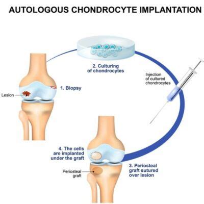 Autologous Chondrocyte Implantation Aci Carticel Knee Surgeon