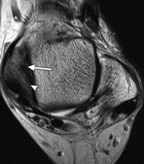 Deltoid Ligament Ultrasound