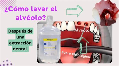 Cómo lavar y limpiar el alvéolo dental después de una extracción dental