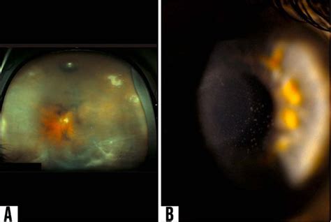 Concomitant Herpetic Keratitis And Acute Retinal Necrosis Clinical