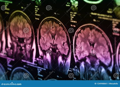 The X-ray of the Human Brain Stock Photo - Image of health, healthcare ...