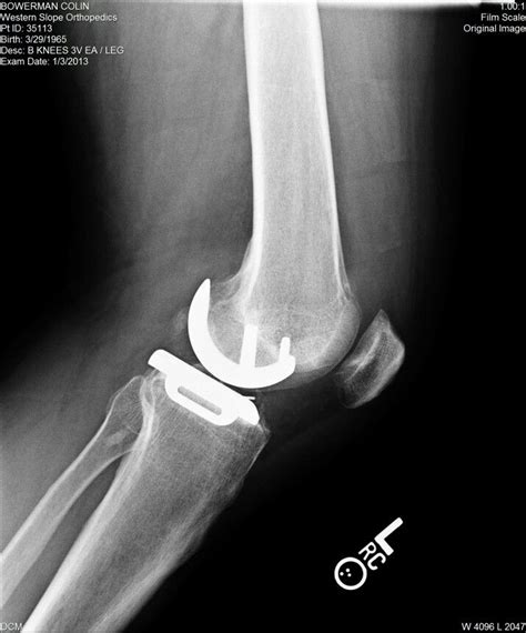 Oxford Partial Knee Replacement Partial Knee Replacement Ballet