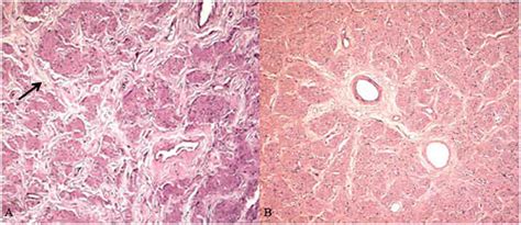 Xeroderma Pigmentosum Histology