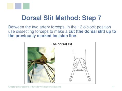 PPT - Dorsal Slit Method PowerPoint Presentation, free download - ID:972918