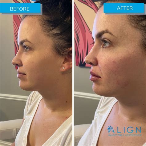 Before And After Cheek Filler Align Injectable Aesthetics