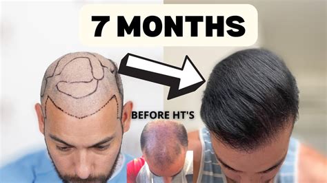 7 Month Hair Transplant Update 4000 Grafts 9k Total Youtube