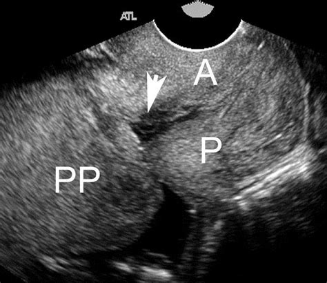 Transvaginal Sonogram Of A Complete Placenta Previa Pp Note That