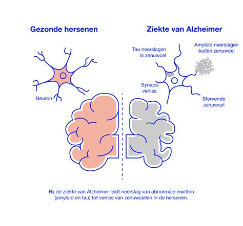 Alzheimer Oorzaken Hoe Komt Het Brain Research Center