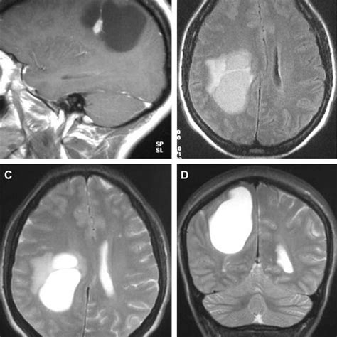 MRI Corresponding To The Same Patient A T1 Weighted Sequence With