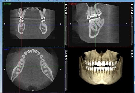 Revolutionizing Dental Implant Planning With Cbct Imaging