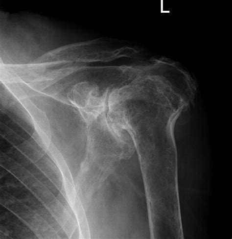 Rheumatoid Arthritis The Bone School