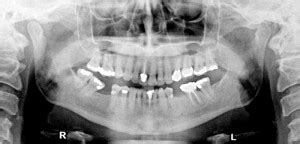 Case of the Week: Palatal Tori – Dr. G's Toothpix