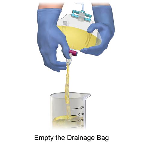 Foley Catheter Documentation Example