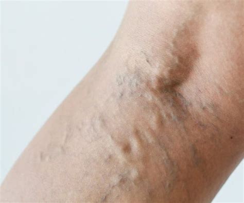 Varicose Vein Removal Vienna Gentle And Painless