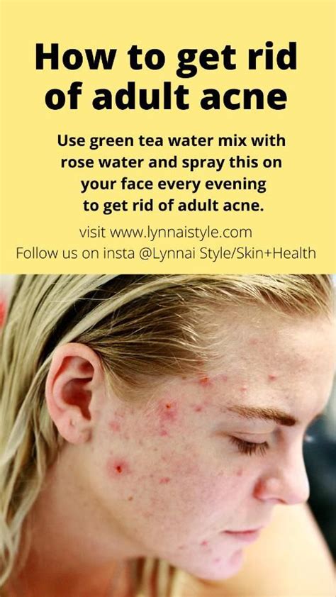 How To Get Rid Of Adult Acne Artofit