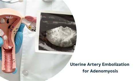 Uterine Artery Embolization For Adenomyosis A Treatment Invasive Solution