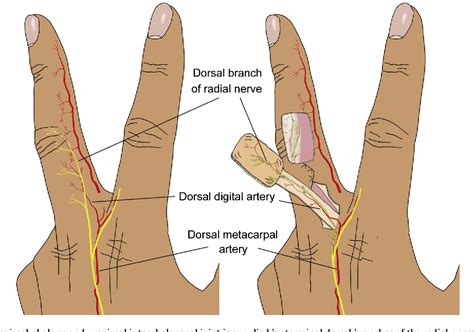 Figure 10 From Reconstruction Of A Soft Tissue Defect In The Finger Using The Heterodigital