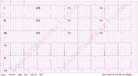 Left Ventricular Hypertrophy With Strain Pattern Example 1